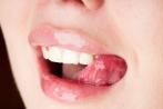 Spröde Lippen wegen des kalten Wetters müssen nicht sein