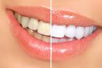 Rauchen schadet Zahnfleisch und Zähnen sehr